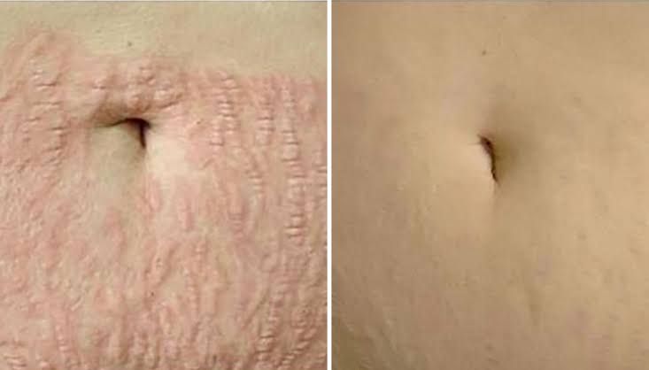 Antes e depois de tratamento de estrias — atende Penha e Vila Matilde, Método Regenera