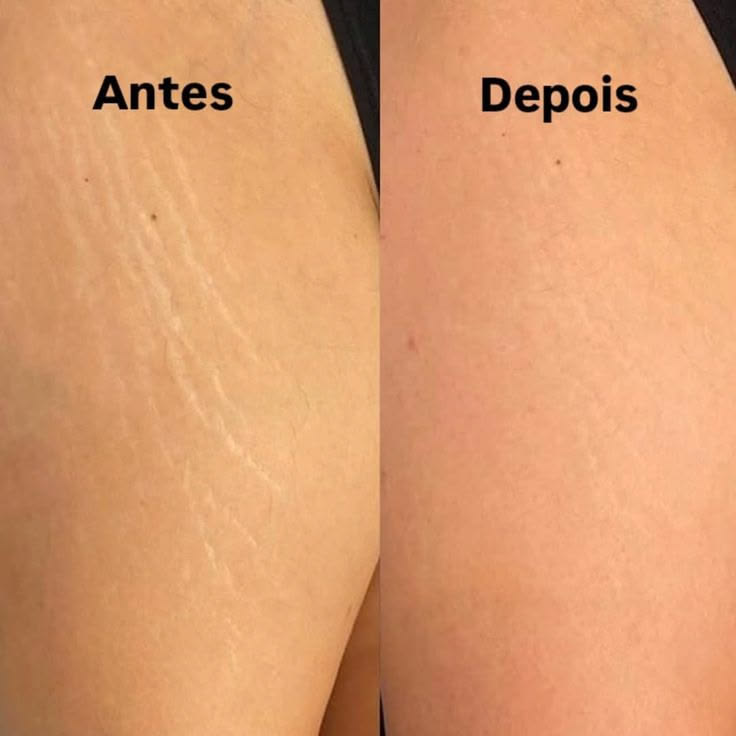 Antes e depois de tratamento de estrias — atende Vila Formosa e Carrão, Método Regenera