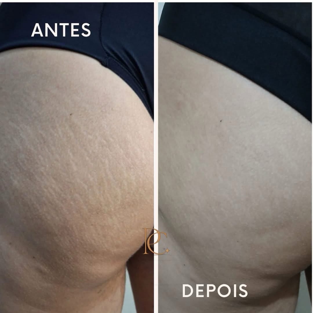 Antes e depois real do tratamento de estrias com o Método Regenera