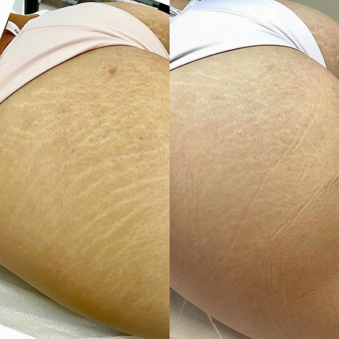 Evolução da textura da pele durante o tratamento de estrias